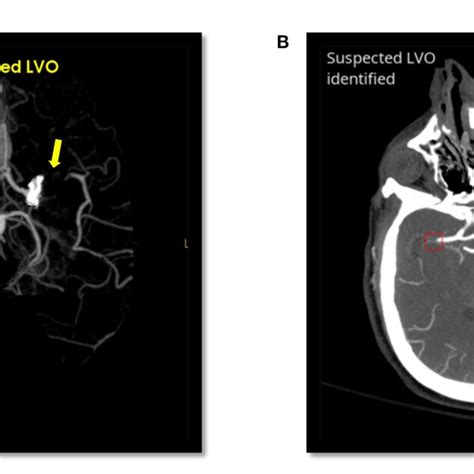 lvo positive stroke